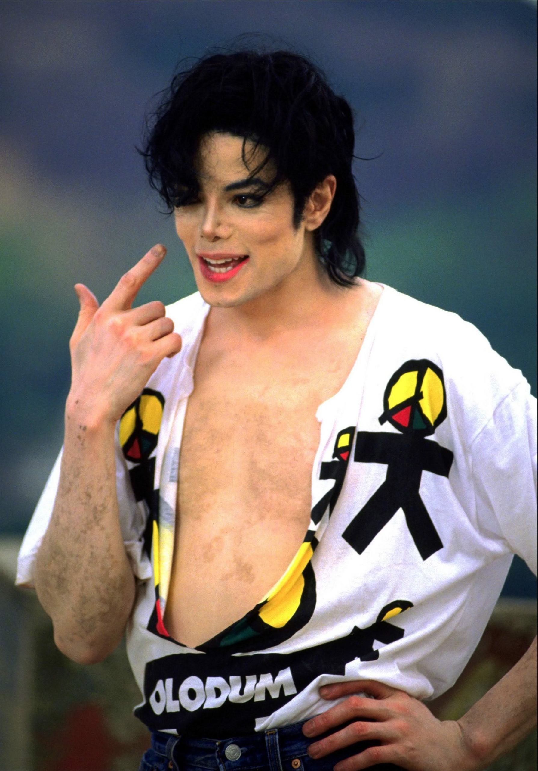 Vitiligo Prince Michael Jackson